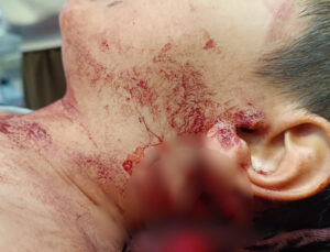 Muş’ta Köpek Saldırısına Uğrayan Çocuğu Isıran Köpekte Kuduz Tespit Edildi