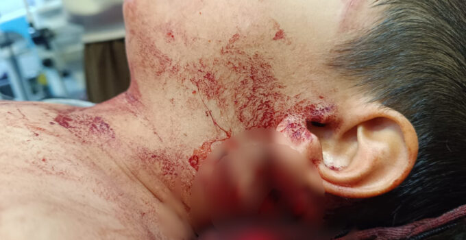 Muş’ta Köpek Saldırısına Uğrayan Çocuğu Isıran Köpekte Kuduz Tespit Edildi