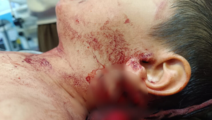 Muş’ta Köpek Saldırısına Uğrayan Çocuğu Isıran Köpekte Kuduz Tespit Edildi