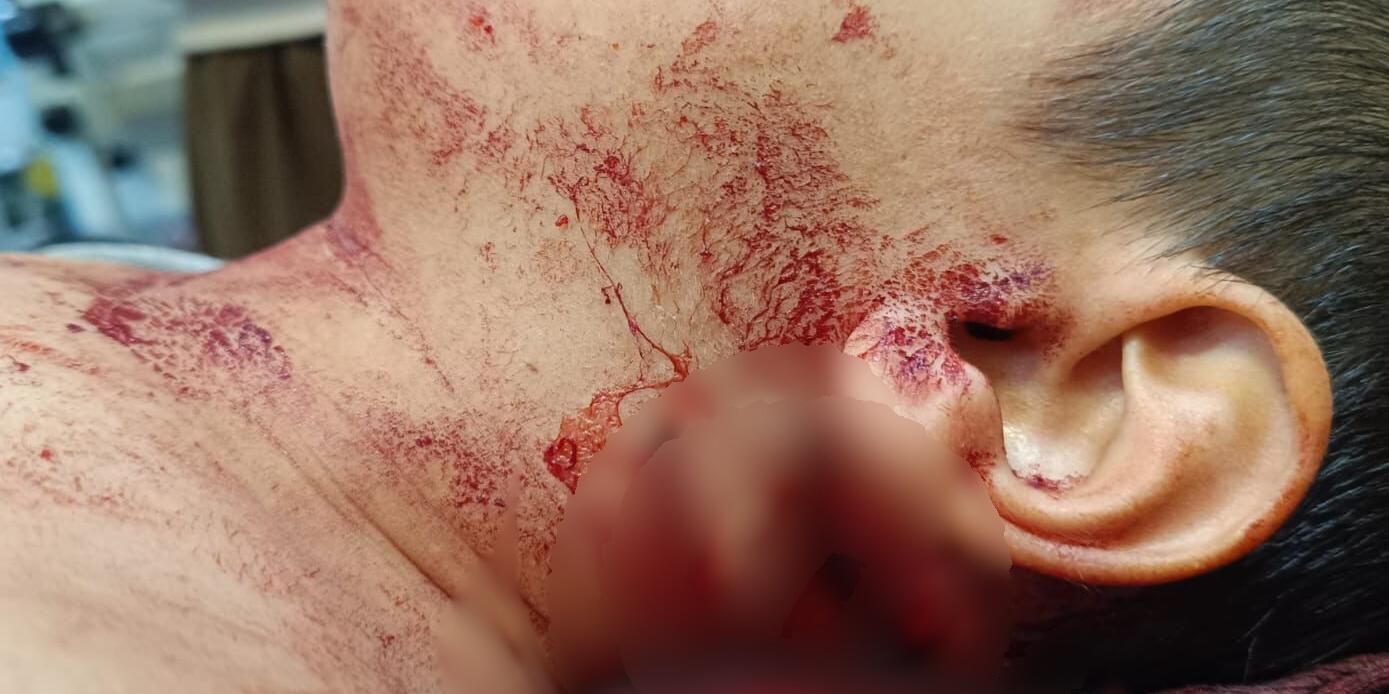 Muş’ta Köpek Saldırısına Uğrayan Çocuğu Isıran Köpekte Kuduz Tespit Edildi